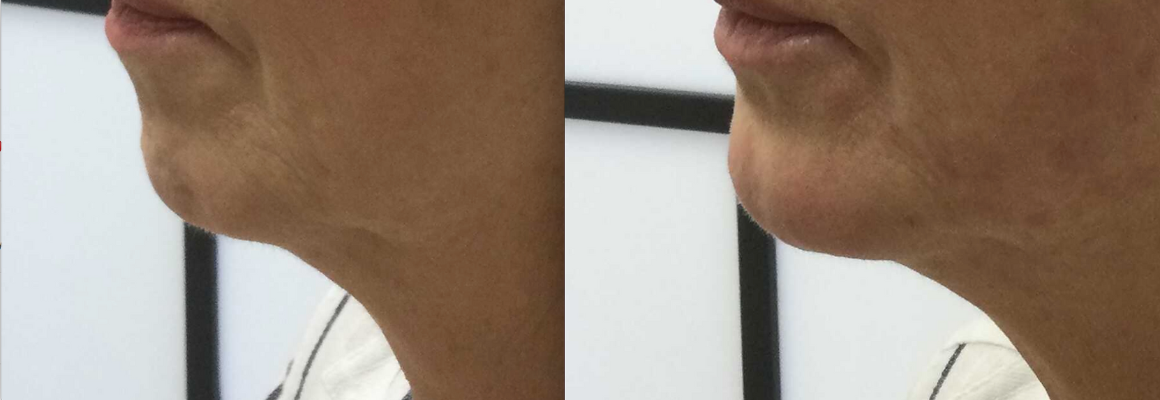 Chin Recession and Lax Jawline