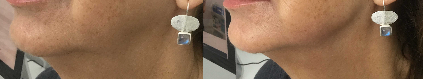 Chin Recession and Lax Jawline