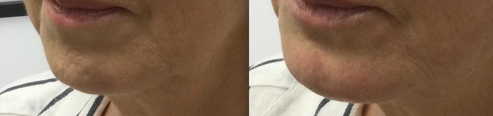 Chin Recession and Lax Jawline