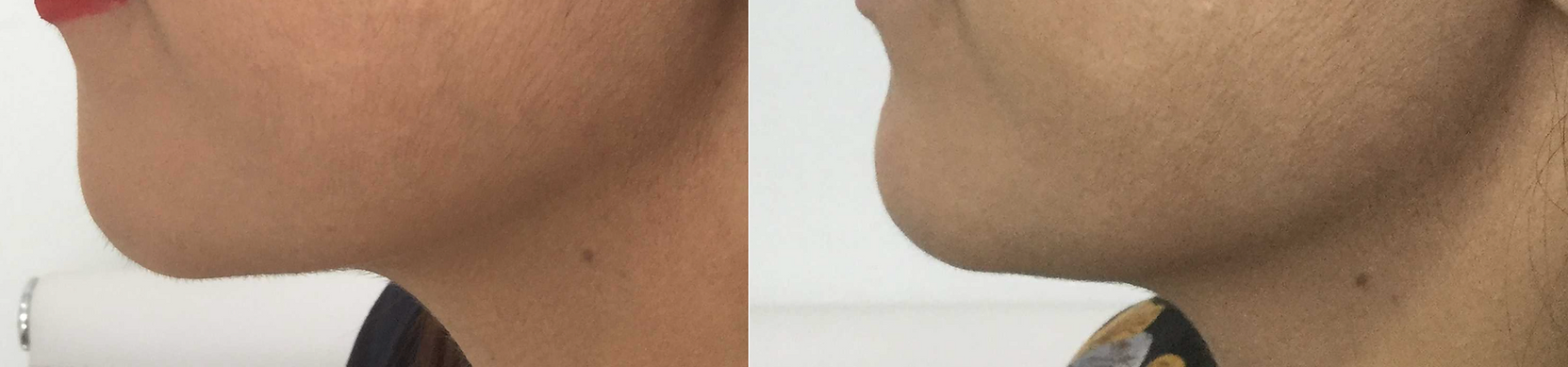 Chin Recession and Lax Jawline