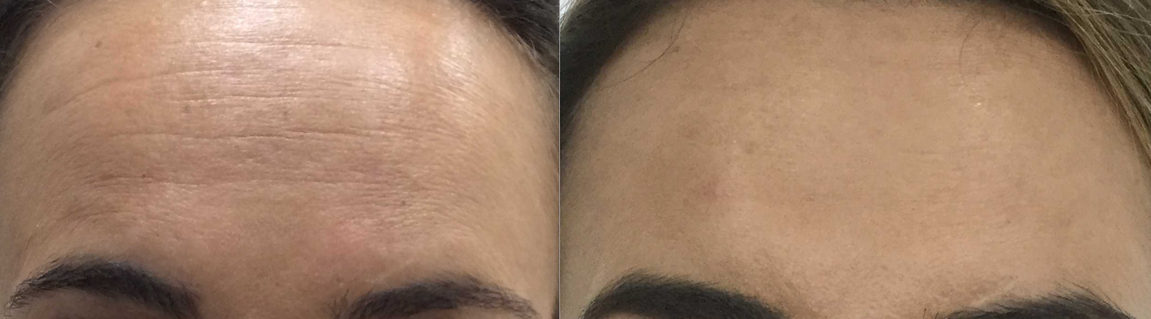 Forehead Before and After Botox