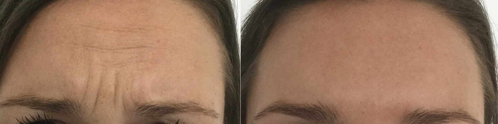 Forehead Before and After Botox