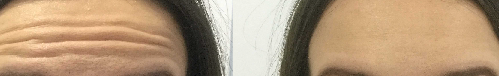 Forehead Before and After Botox