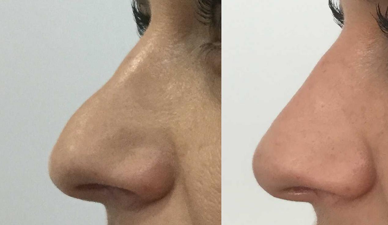 Rhinoplasty