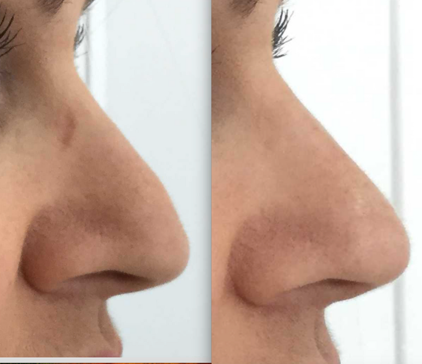 Rhinoplasty