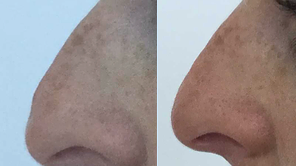 Rhinoplasty