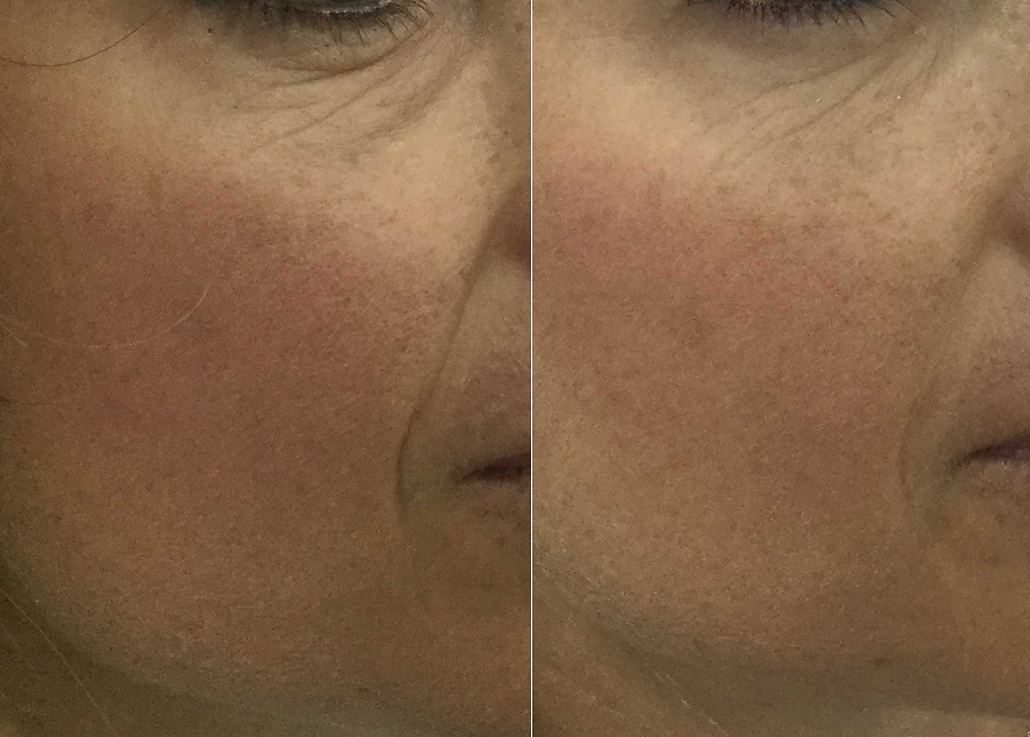 face lift without surgery