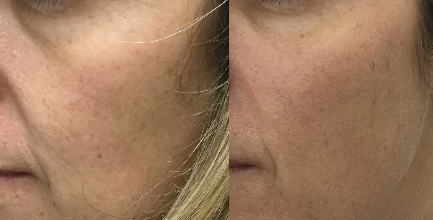 face lift without surgery